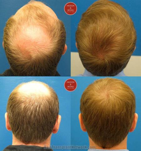 Hair transplantation surgery before and after photos