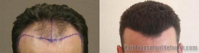 Hair transplant results front view