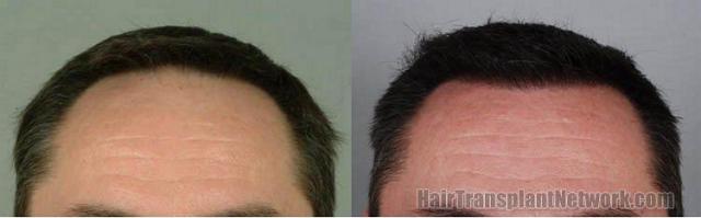 Hair restoration patient photos showing front view