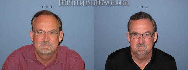 Hair transplant photos before and after surgery