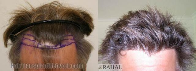 Hair restoration procedure before and after pictures