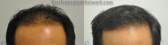 Hair restoration procedure before and after results