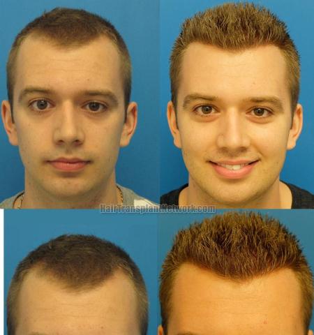 Hair restoration procedure before and after results