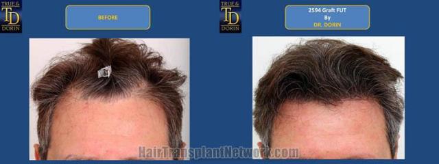 Hair restoration procedure before and after results