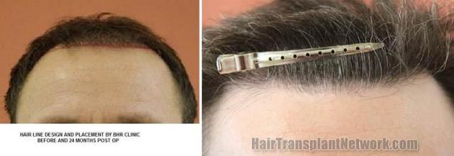 Hair restoration procedure before and after results