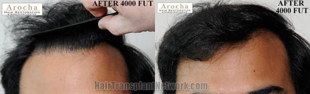 Hair restoration procedure before and after results