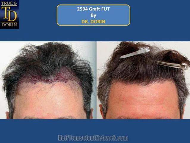 Hair restoration surgery before and after photos