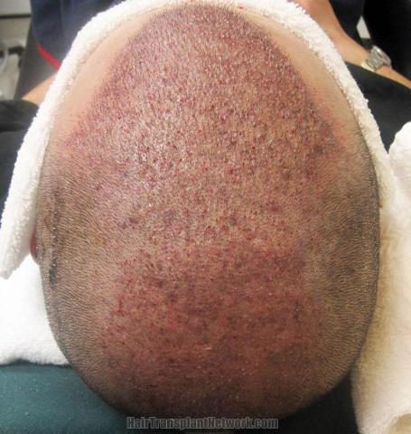 Hair transplantation surgery before and after photos