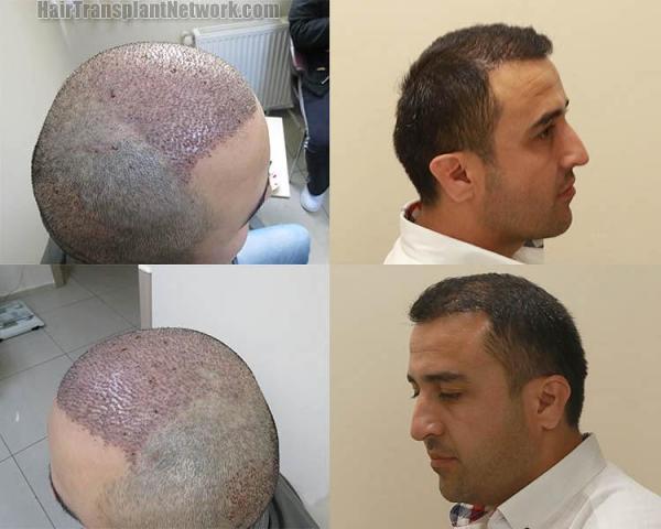 Hair transplantation surgery before and after images