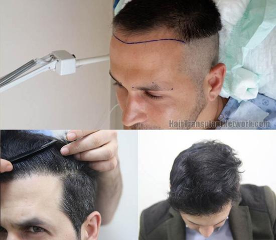 Hair transplant surgery before and after photos