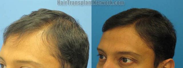 Hair transplantation surgery before and after pictures