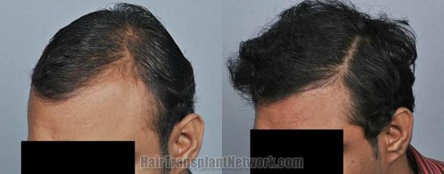 Hair transplantation surgery before and after photos