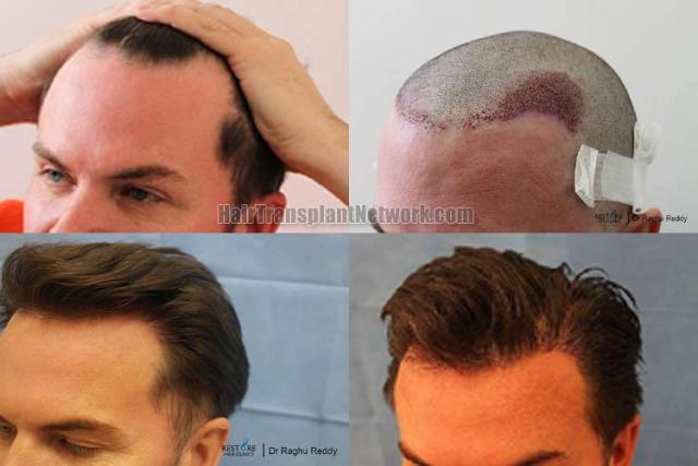 Hair transplantation surgery before and after pictures