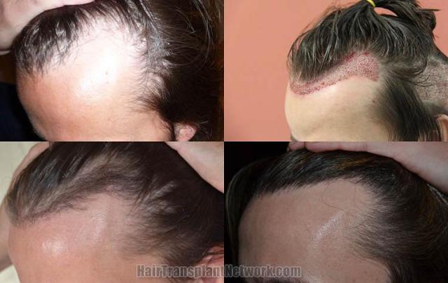 Hair transplantation surgery before and after pictures