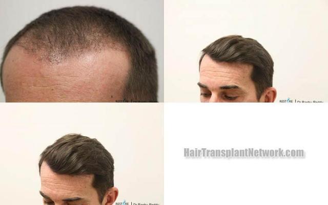 Hair transplantation surgery before and after images