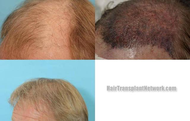 Hair restoration procedure before and after pictures