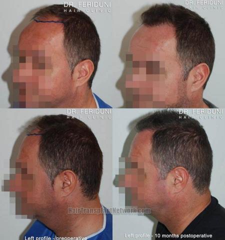 Hair transplantation surgery before and after pictures