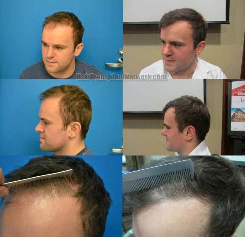 Hair transplantation surgery before and after photos