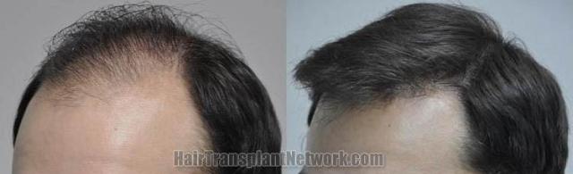 Hair transplantation surgery before and after photos