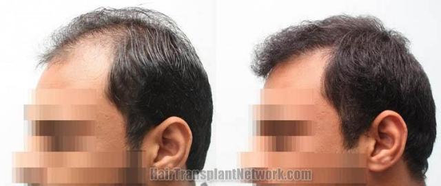 Hair transplantation surgery before and after images