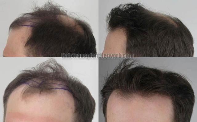 Hair transplantation surgery before and after pictures