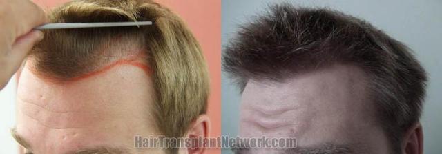 Surgical hair transplantation result photographs