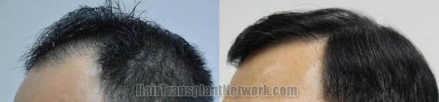 Hair restoration procedure before and after pictures