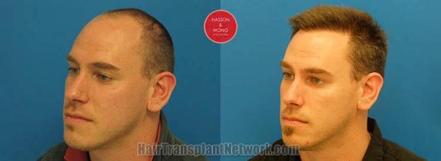 Hair transplantation surgery before and after pictures