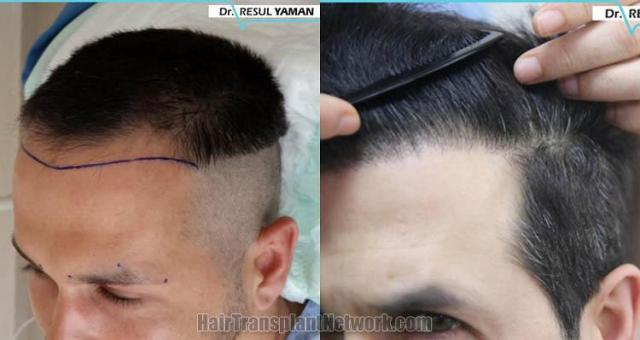 Hair transplantation surgery before and after images