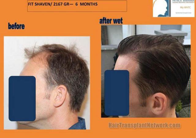 Hair transplantation surgery before and after pictures