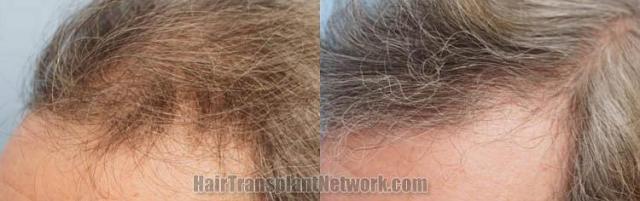 Hair transplantation surgery before and after images