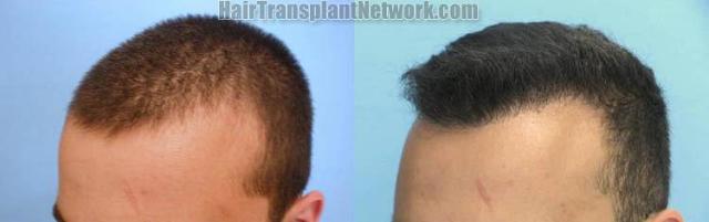 Hair restoration procedure before and after pictures