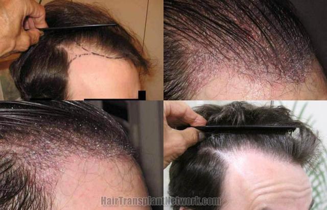 Hair restoration procedure before and after pictures