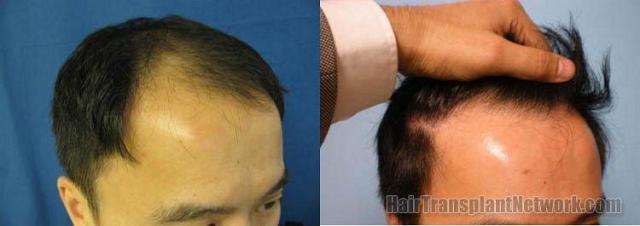 Results from 1742 graft hair replacement procedure