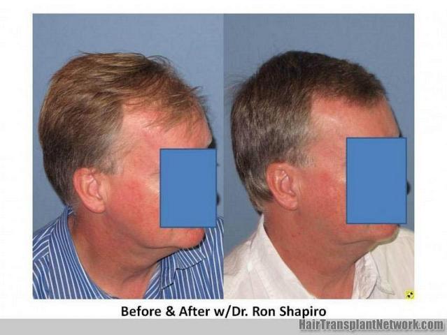 Right side view of before and after hair transplant results