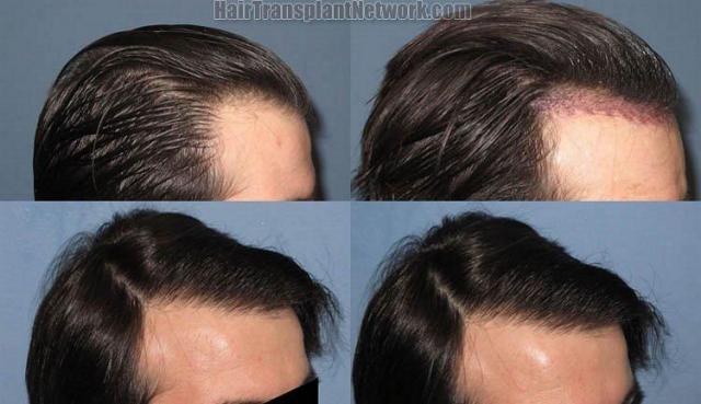 Hair restoration photos viewed from the right