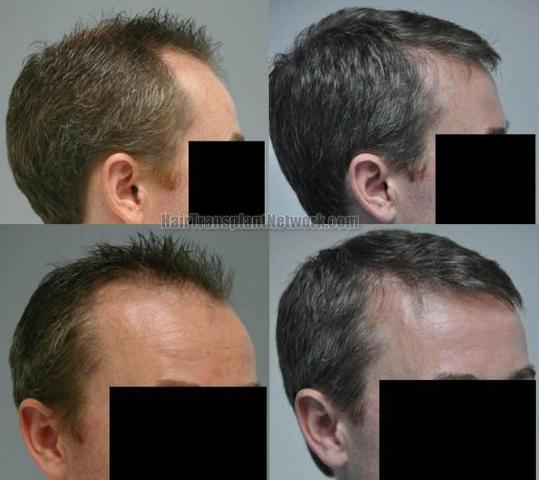 Hair restoration procedure before and after results