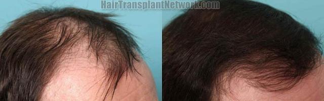 Hair transplantation surgery before and after images