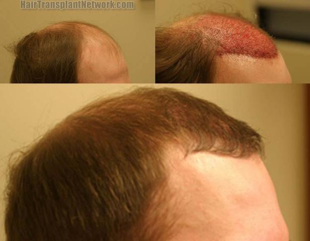 Hair restoration procedure before and after results