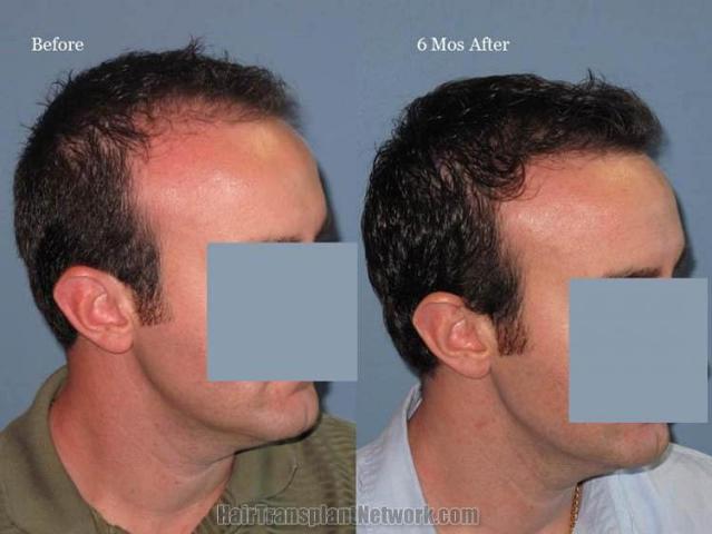 Hair transplantation surgery before and after pictures