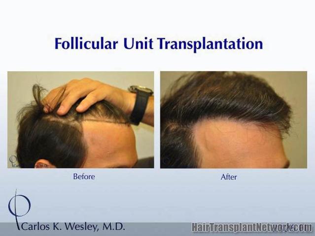 Hair transplantation surgery before and after images