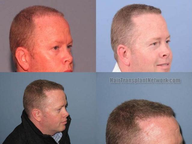 Hair transplantation surgery before and after images