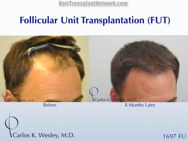 Hair transplantation surgery before and after images