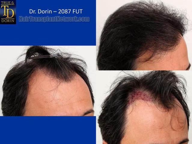 Hair transplantation surgery before and after images