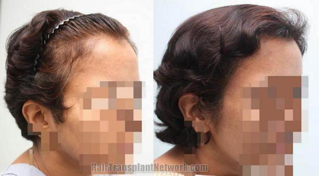 Hair transplantation surgery before and after pictures