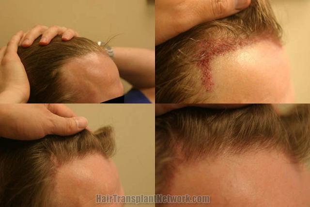 Hair transplantation surgery before and after pictures