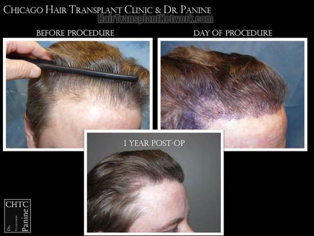 Hair transplantation surgery before and after images