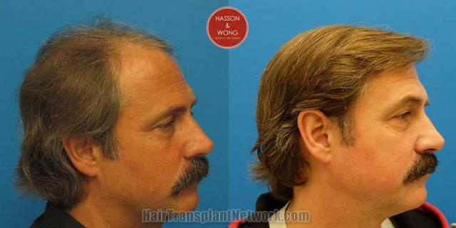 Hair transplantation surgery before and after images