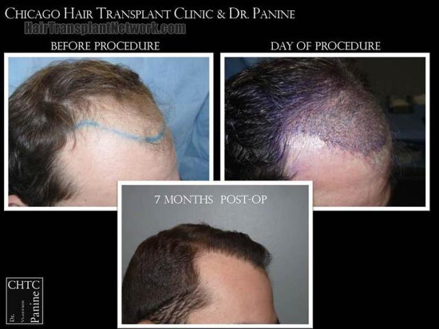 Hair transplantation surgery before and after photos