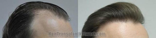 Hair transplantation surgery before and after images